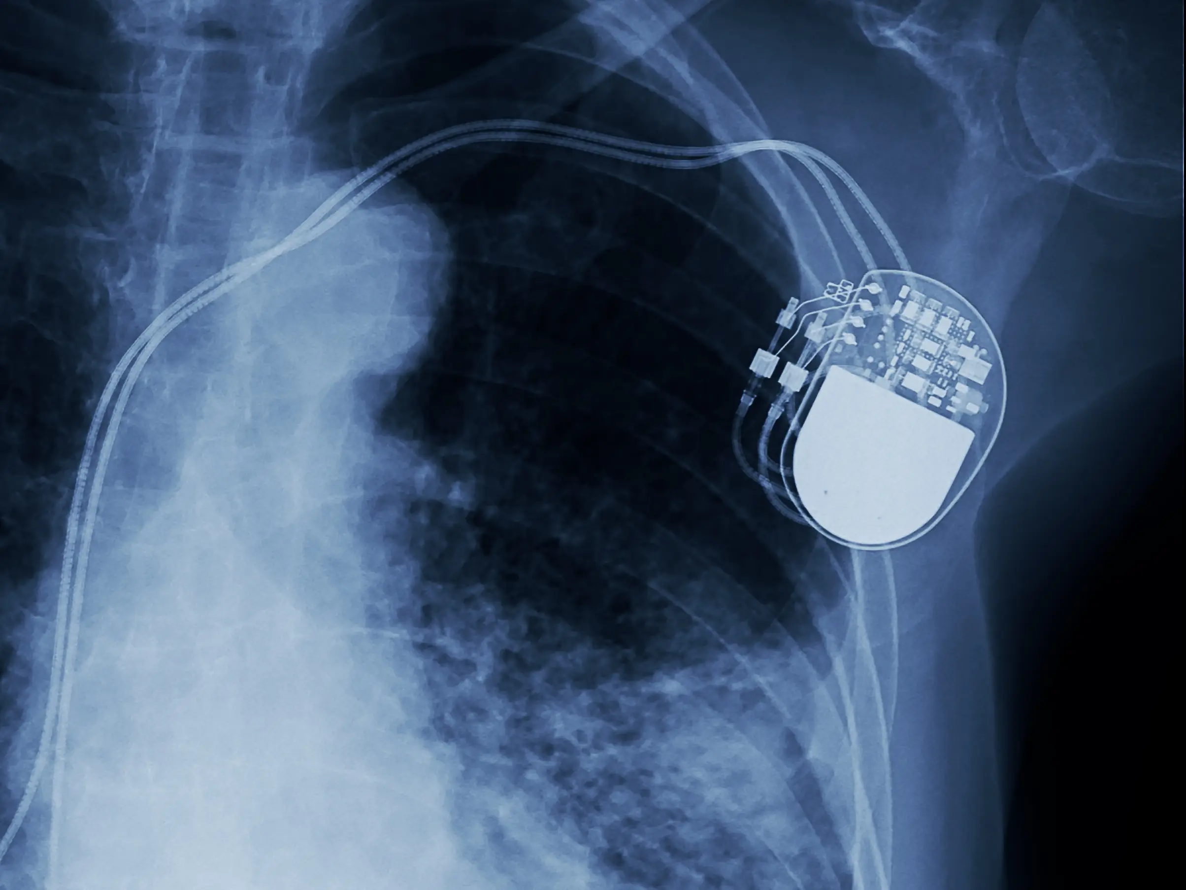Pacemaker chest Xray